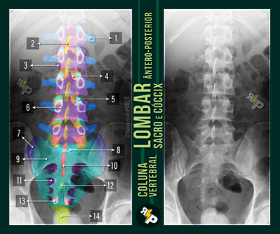 Chicletão Card - Coluna Vertebral - Raio-X Ântero Posterior de Lombar