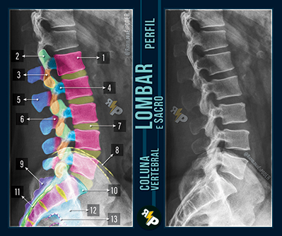 Chicletão Card - Coluna Vertebral - Raio-X Perfil de Lombar