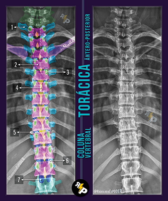 Chicletão Card - Coluna Vertebral - Raio-X Ântero Posterior de Coluna Torácica