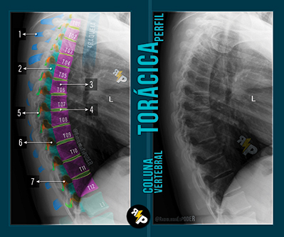 Chicletão Card - Coluna Vertebral - Raio-X Perfil de Coluna Torácica